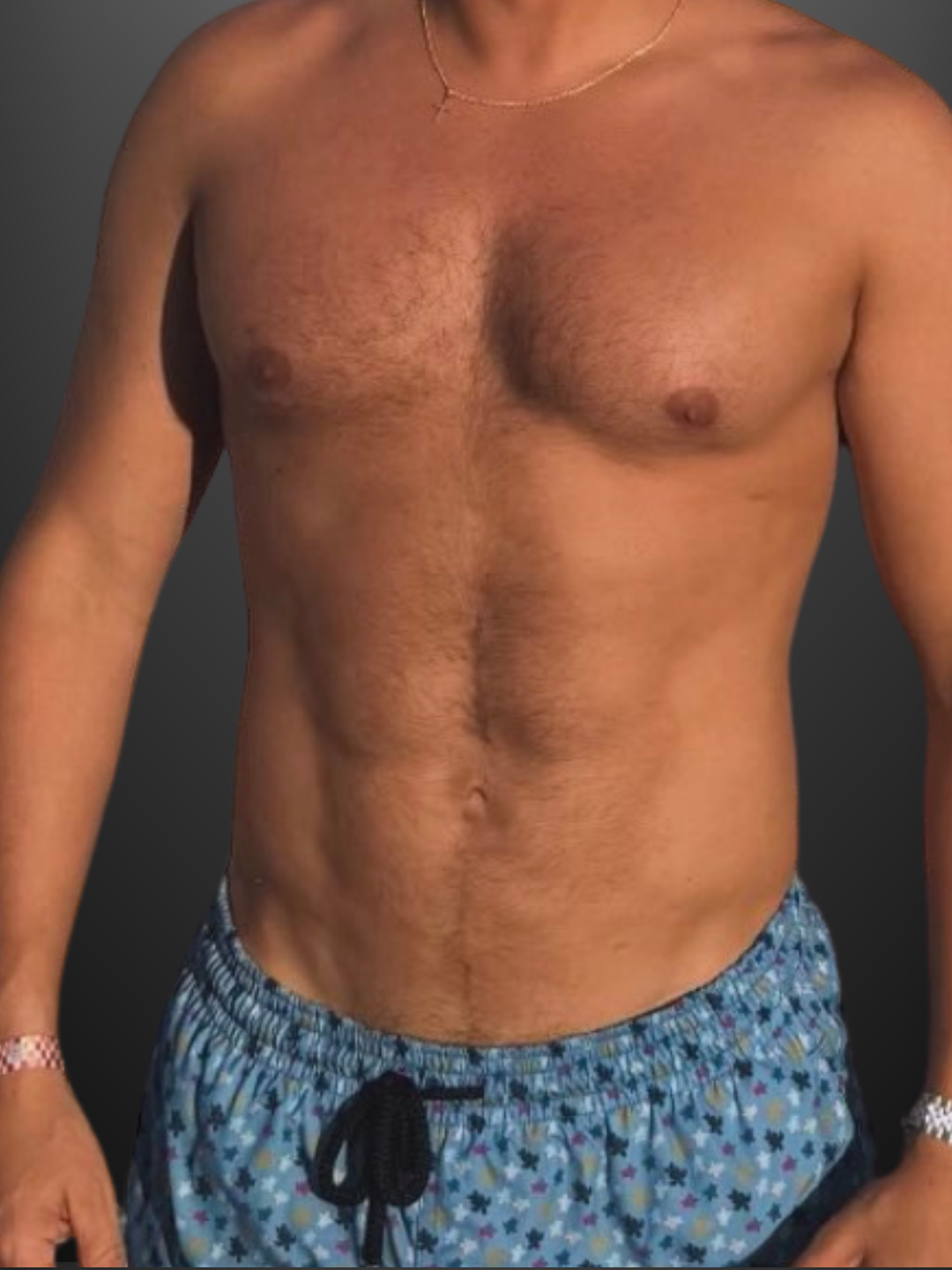 Male HD VASER lipo with pectoral enhancement — post-operative result at six months.