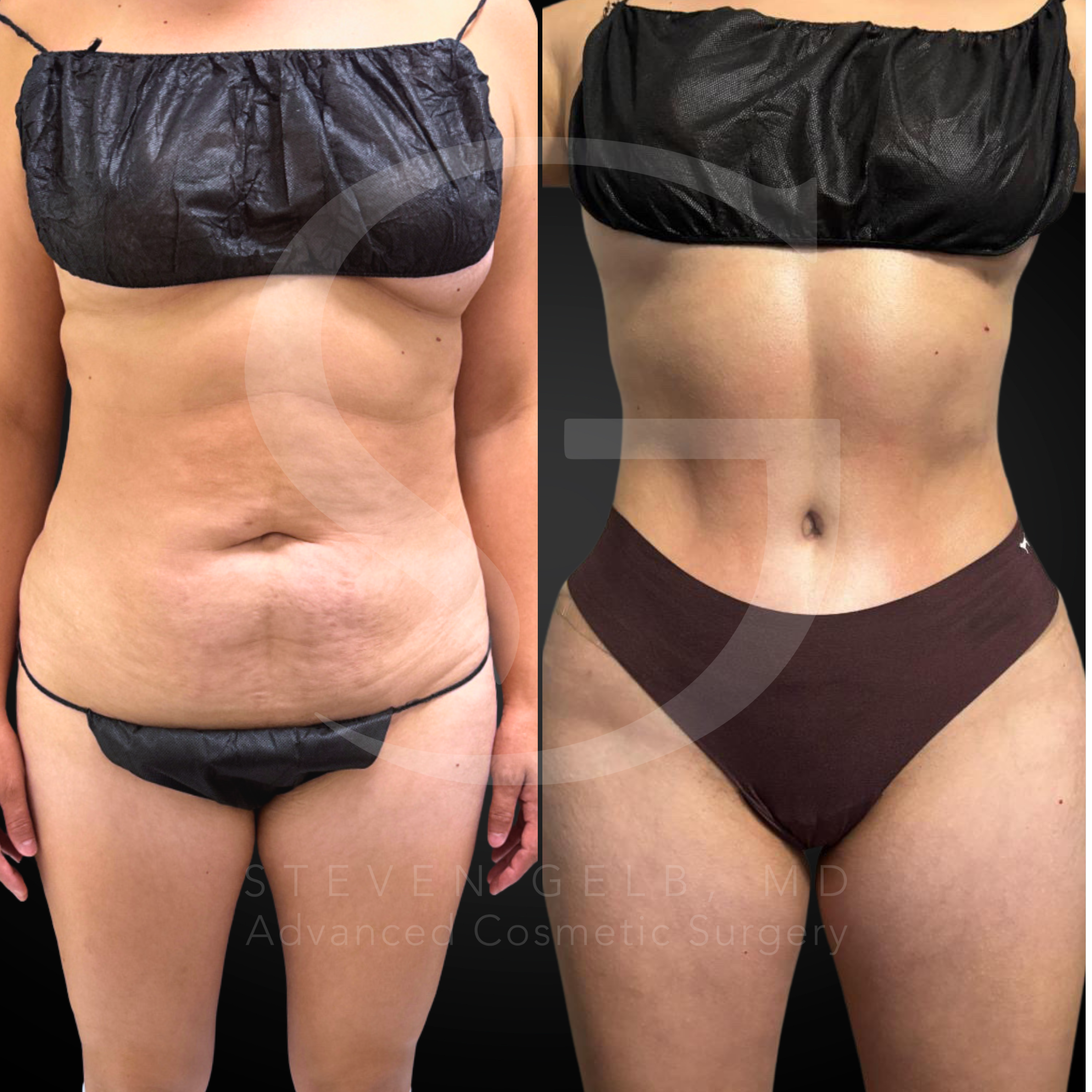 Abdominoplasty before-and-after, 41-year-old female, six months post-op.