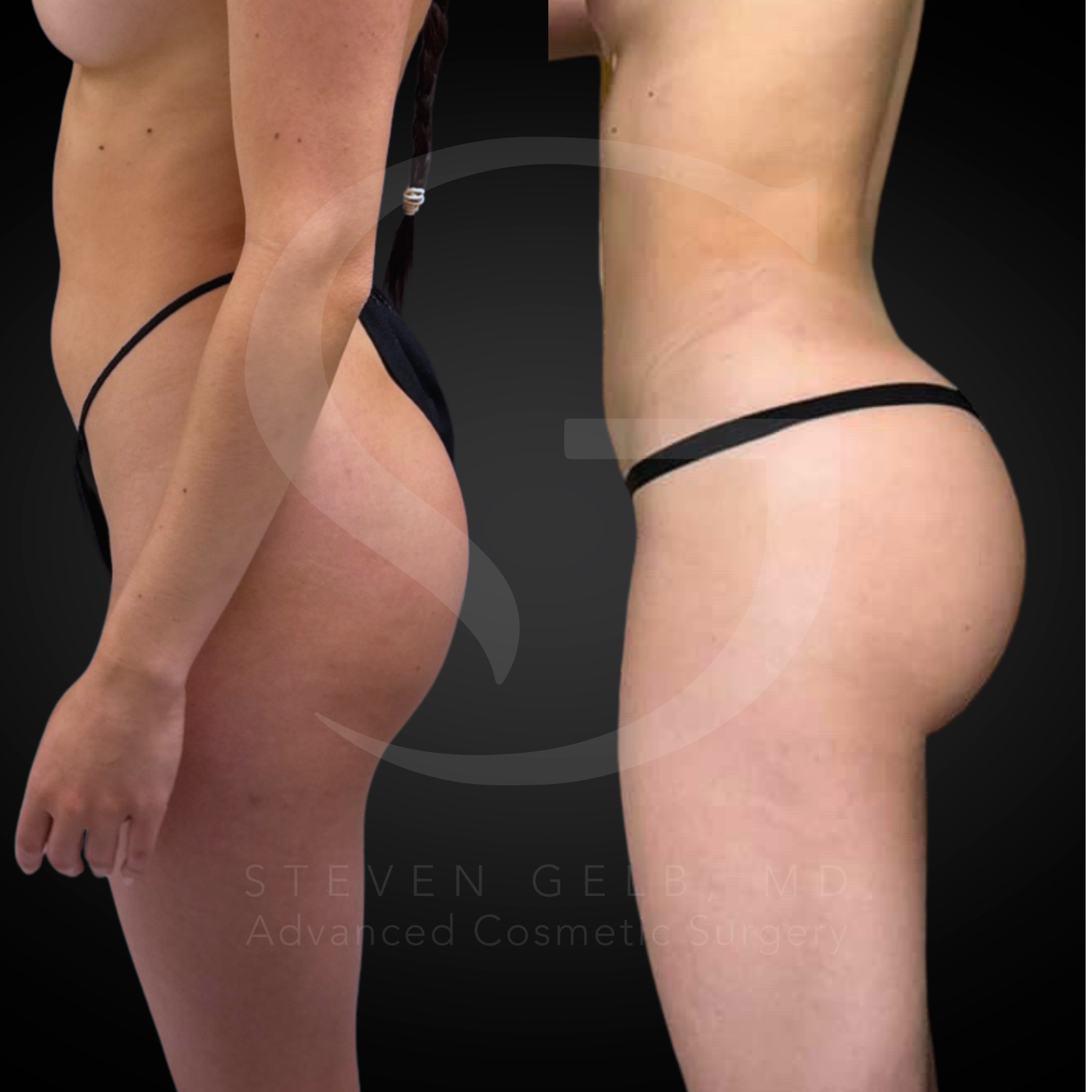 Brazilian Butt Lift before-and-after, 29-year-old female, five months post-op.