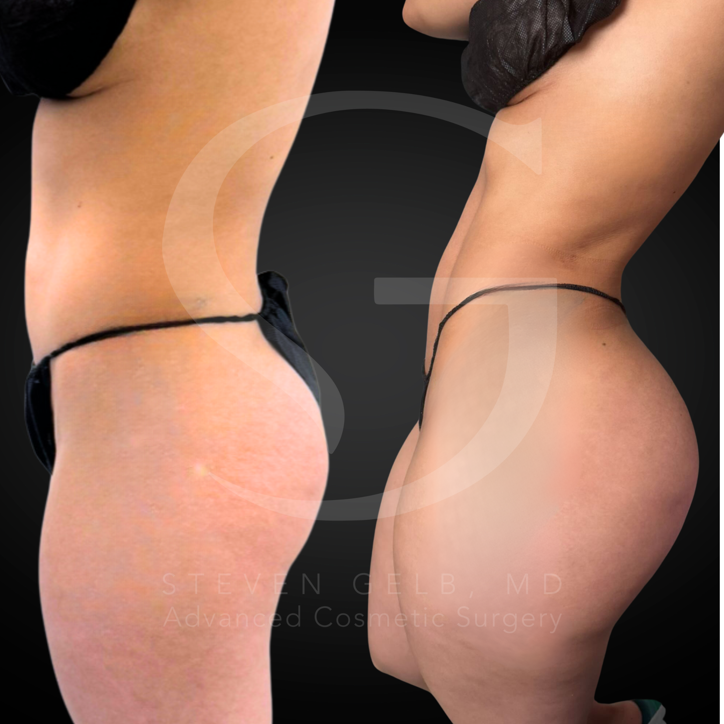 Brazilian Butt Lift before-and-after, 32-year-old female, three months post-op.