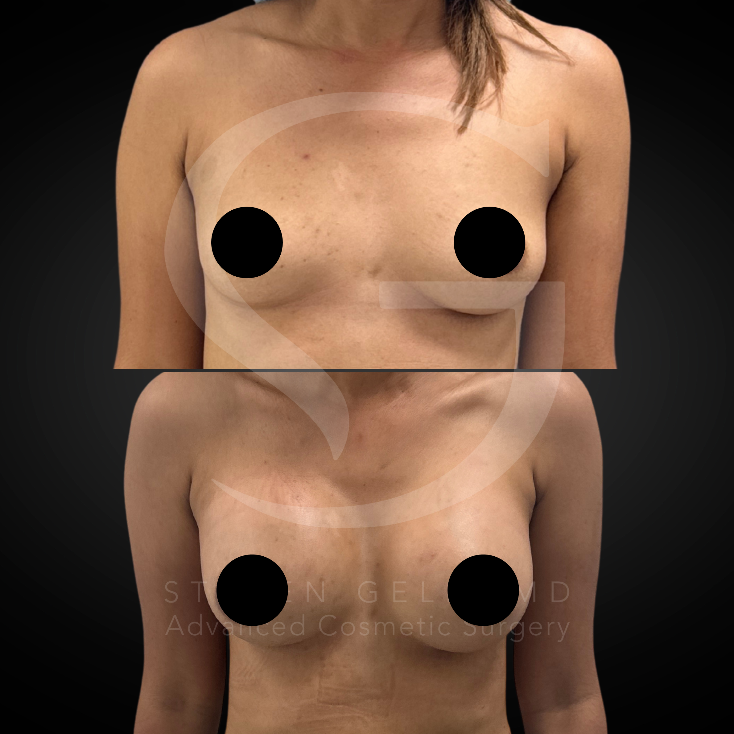 Breast Augmentation before-and-after, 28-year-old female, three months post-op.