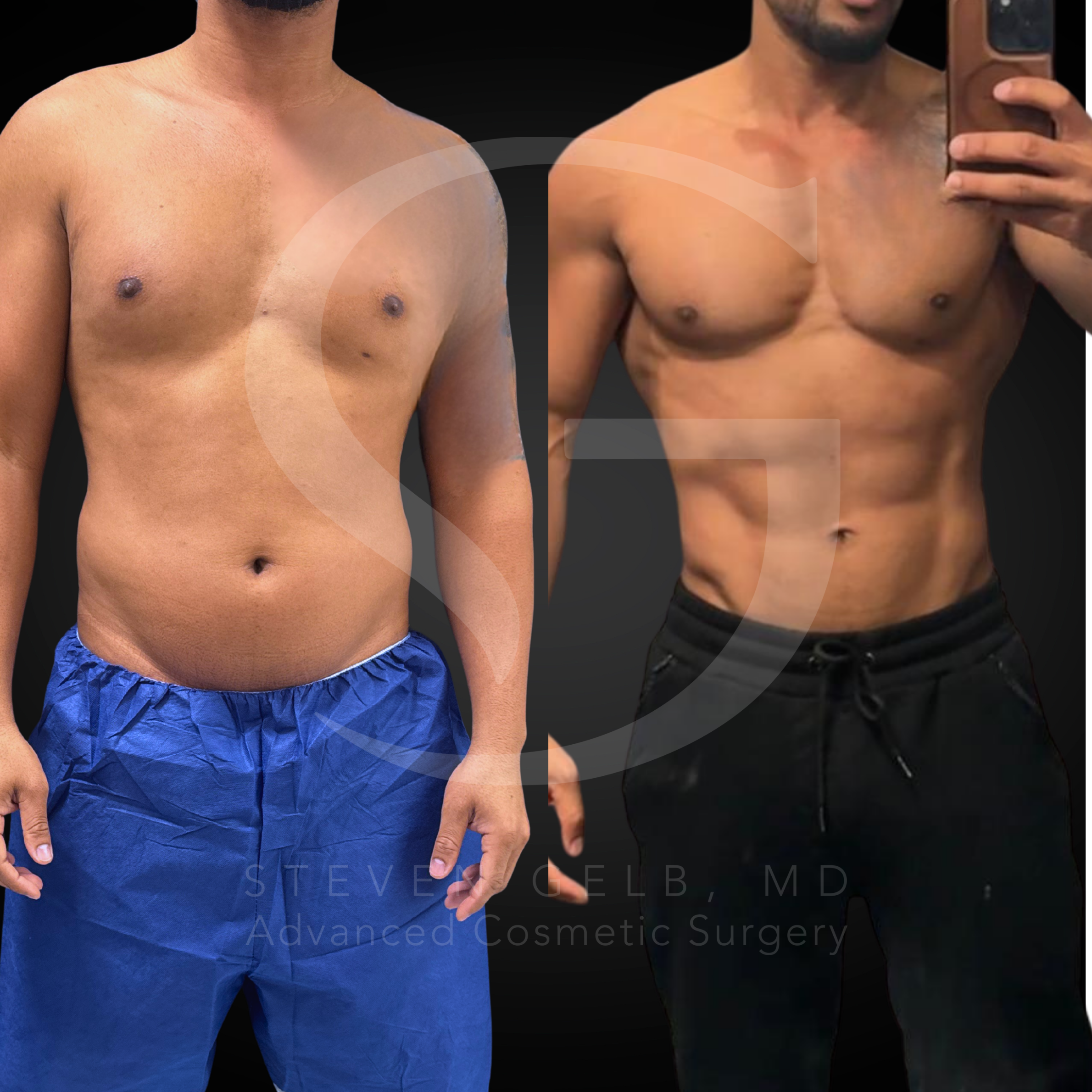 HD Liposuction before-and-after, 35-year-old male, four months post-op.
